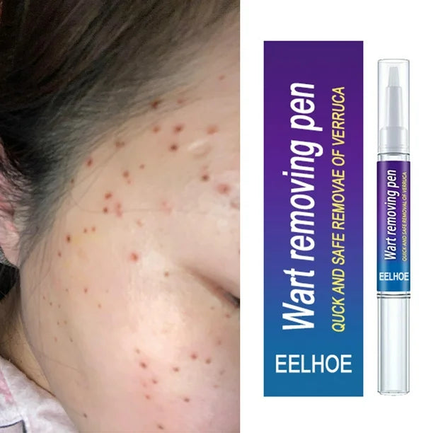 ✨ Stylo Anti-Verrues – Retrouver une peau nette et la confiance de sourire !