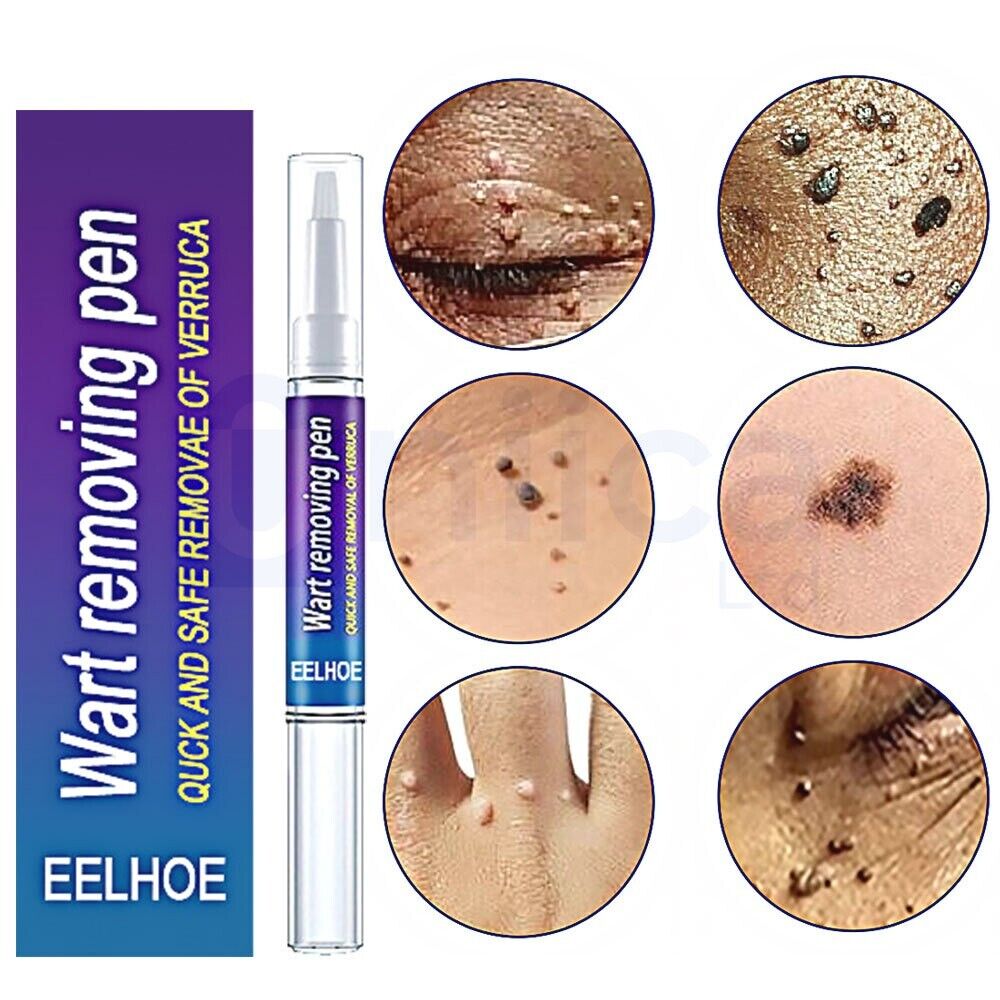 ✨ Stylo Anti-Verrues – Retrouver une peau nette et la confiance de sourire !